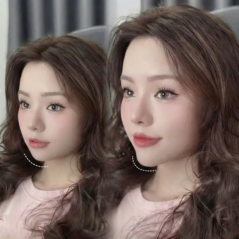 Tiêm cằm vline Phú Quốc