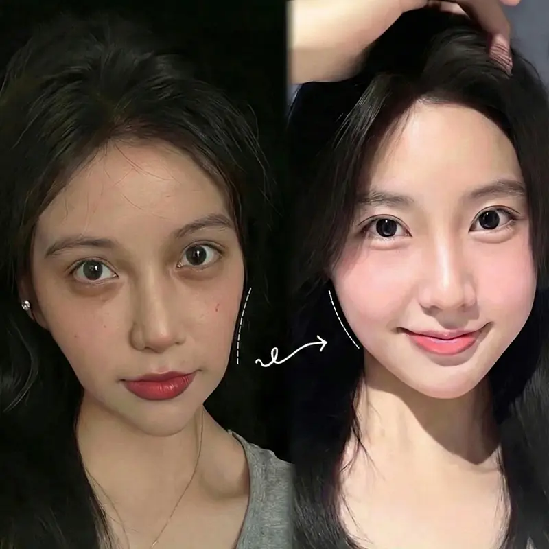 Tiêm má baby Phú Quốc