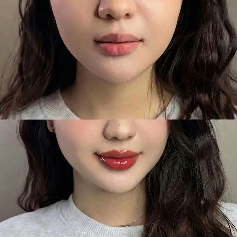 Tiêm môi babie Phú Quốc