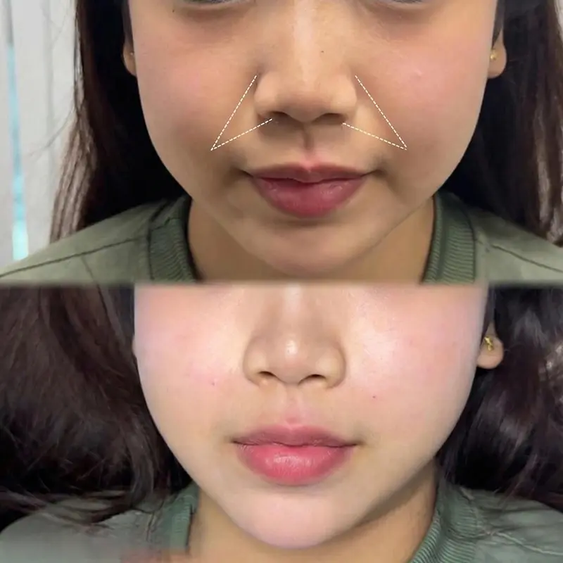 Tiêm xóa nhăn rãnh cười