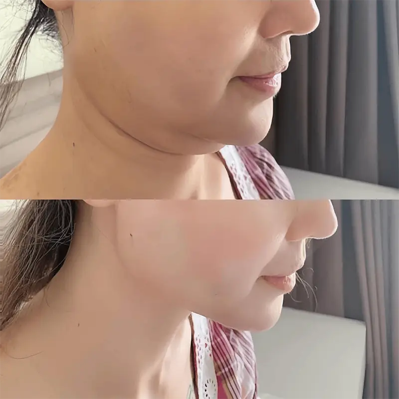 Tiêm tan mỡ nọng cằm